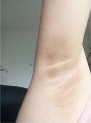 我还没结婚，我的私处不算黑，但是我的腋下太黑了，夏天穿裙子都不好意思抬手，被别人看到那么黑，太尴尬了。我就想着试试，没想到效果那么好