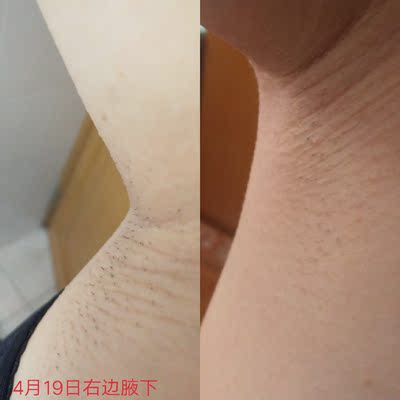 点评绝不偏颇的对比可思美和ulike哪个好，到底哪款真正好用？