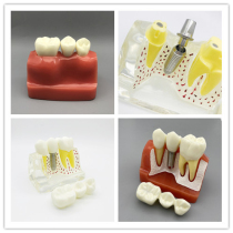 Dental Dentistry Material 4 Times Planting Tooth Narration Model Planting Nails Oral Teaching Doctor-patient Communication