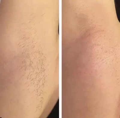 脱完还是很干净的，处女座的我也很满意，连根拔起，腋下不怎么疼，已经用过好多次蜜蜡脱毛了，所以很喜欢这种方法脱毛