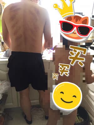 非常好的宝贝，我家中暑再也不怕刮痧烦啦！拔罐也很不错，还能加热，两次用过就很方便操作啦，当然，个人手法也是了得哈，这痧刮的是不是很专业？啊哈哈哈哈哈