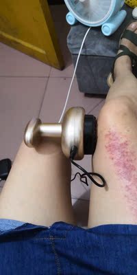 东西今天收到的，迫不及待用了，效果很好，可能是我不受力，感觉吸力好大啊，已经调到最小了吸的我还是痛，出了很多的痧气，做完了腿挺舒服，下次叫我老公给我做背，坚决支持，真的不错呢，价格也实惠，南极人的忠实拥护者，我可不是托