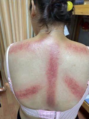 太厉害了，一滑就能滑出痧来