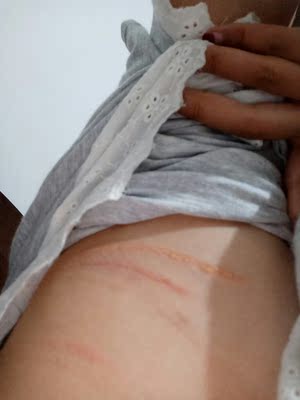 内衣那都好，显胸小，不聚拢是我喜欢的，但是太伤害皮肤了，只穿了两天就磨成这样，而且还痒的难受，穿这个内衣简直跟受罪一样