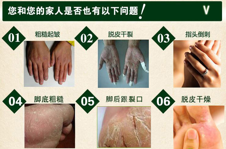 盛凯源皲裂护肤膏手足皲裂膏干燥脱皮手裂脚裂
