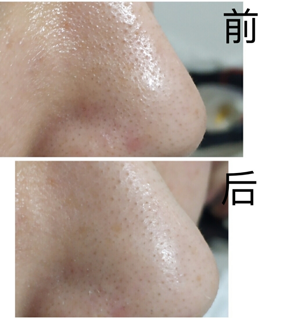 吸黑头仪使用后完全没有效果