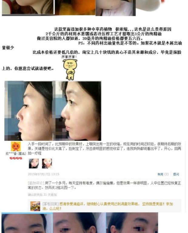 龅牙地包天修复精油嘴突矫正内收颚骨后推收牙槽床骨嘴巴前突凸出