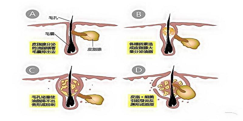 为什么你的闭口黑头粉刺比别人多？