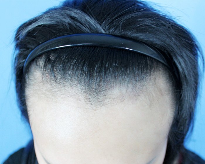 美人尖倒着长?原来是发际线后移的征兆