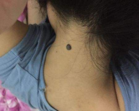 身上的痣渐渐多了?别轻视,有些是致癌