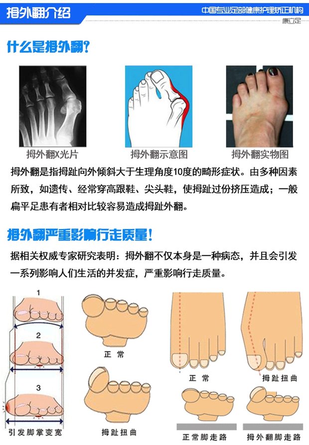 日夜用拇外翻矫正器大脚骨痛大拇指外翻小脚趾内翻脚掌变宽矫正套