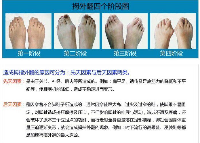 拇外翻矫正套大小脚趾外翻矫正器医 用硅胶套姆指分趾垫