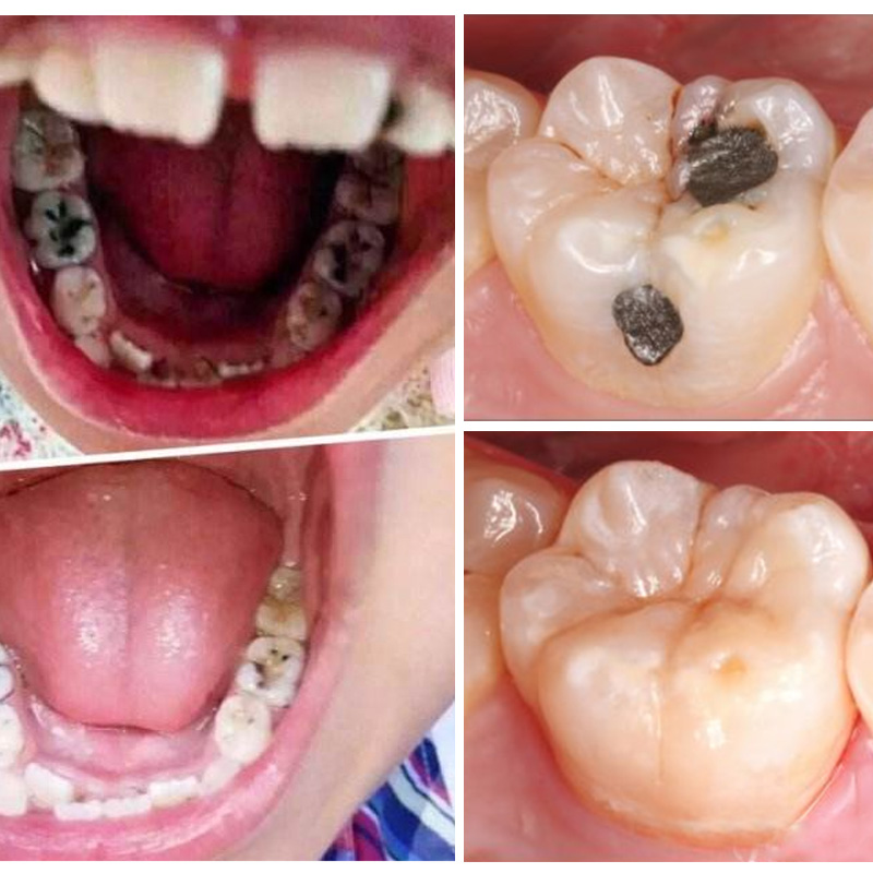 去黄口臭烟渍牙结石洗牙粉口气清新酵素小苏打牙膏非牙齿美白神器_爱
