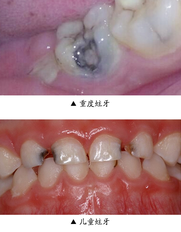 苏御园成人儿童牙粉非防蛀牙修复牙洞膏黑斑龋齿牙疼