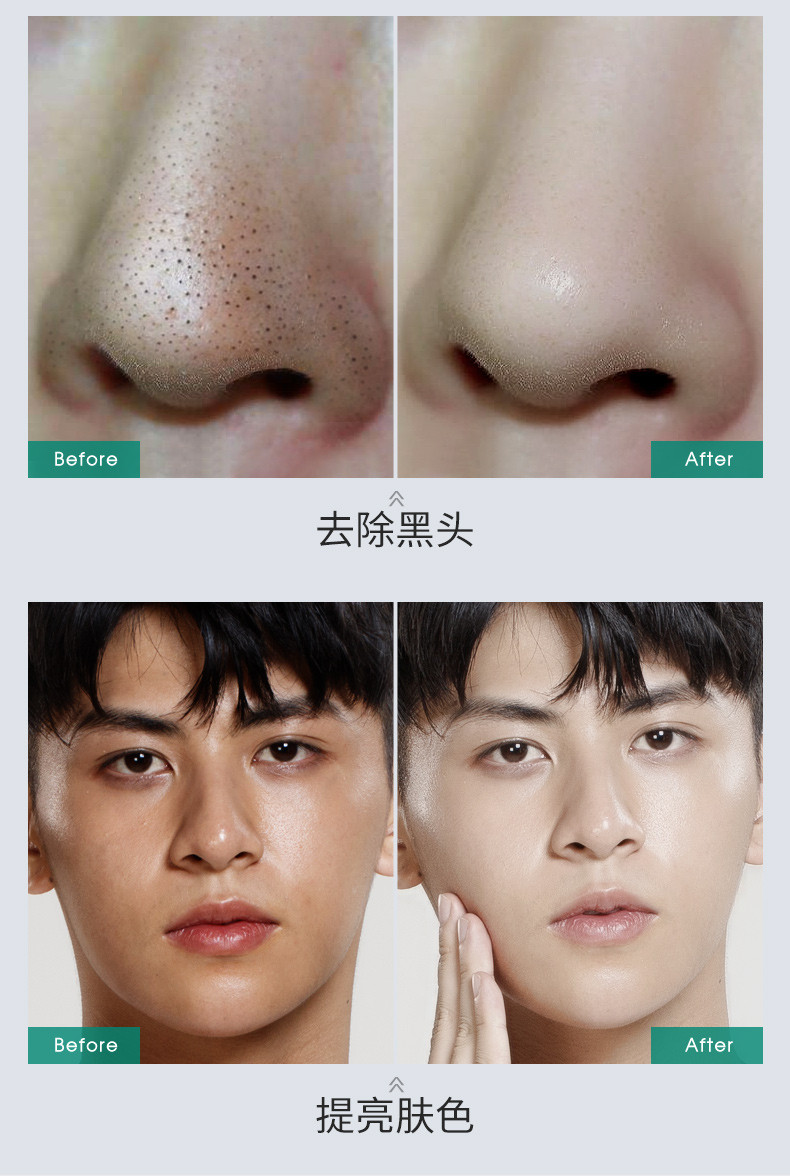 男士去痘坑痘印_脸上痘印去如何有效去除_去痘印最有效的偏方