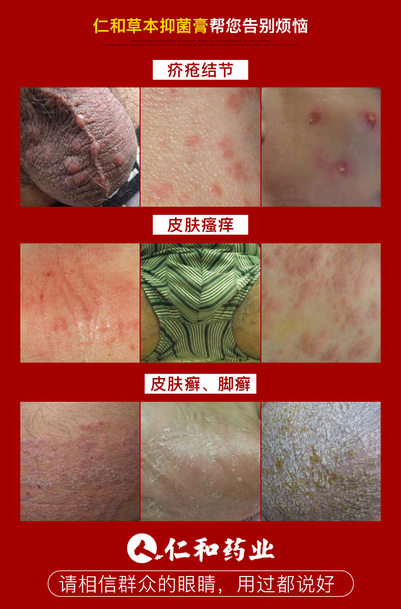 湿疹止痒去根疥疮大腿内侧阴囊外阴肛门屁眼瘙痒男女