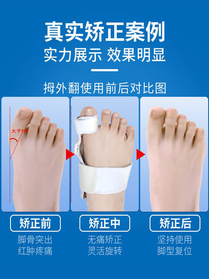 독일 브랜드 썸 valgus 교정기 큰 발 뼈 발가락 굽힘 정형 외과 발가락 스플리터 수정 벨트 도구 독일 브랜드 썸 valgus 교정기 큰 발 뼈 발가락 굽힘 정형 외과 발가락 스플리터 수정 벨트 도구