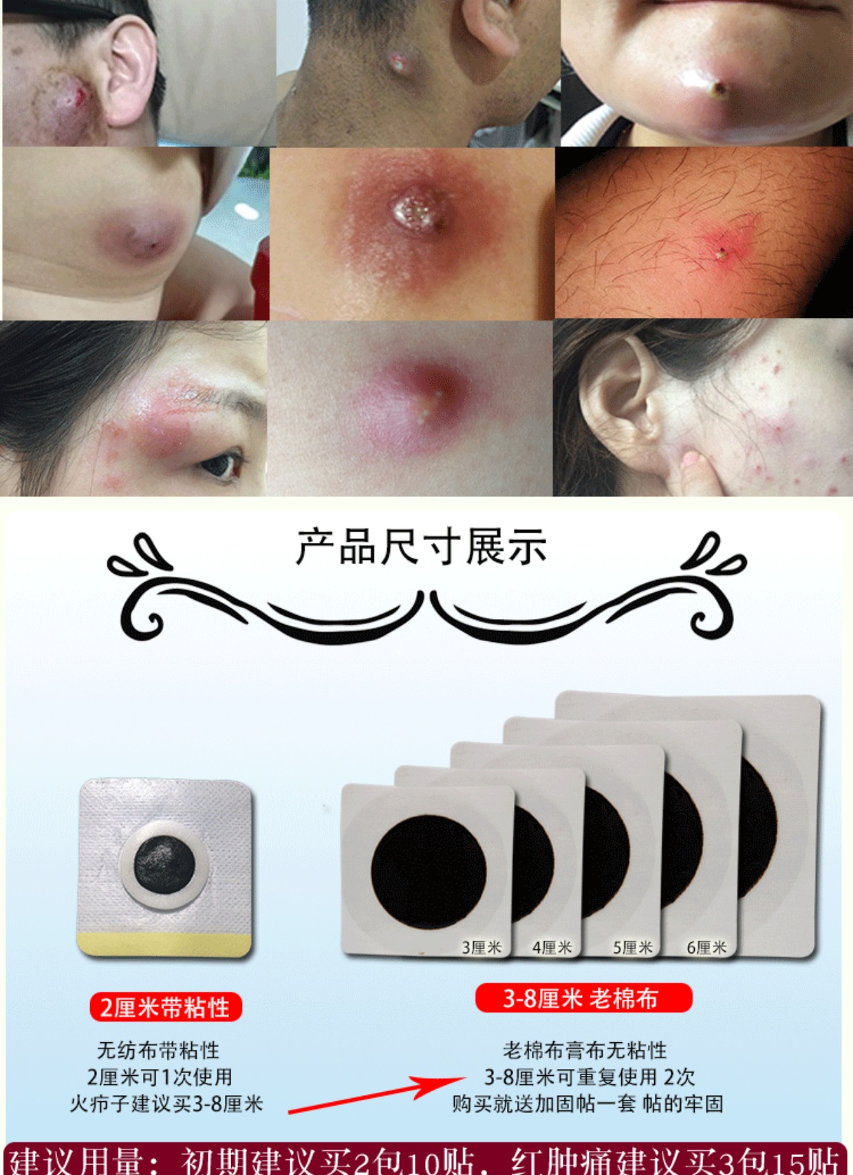 火疖子 拔毒膏拔毒贴膏 拔脓膏 祛痘贴毛囊痘痘痈疔坐板疮 5贴_双氙