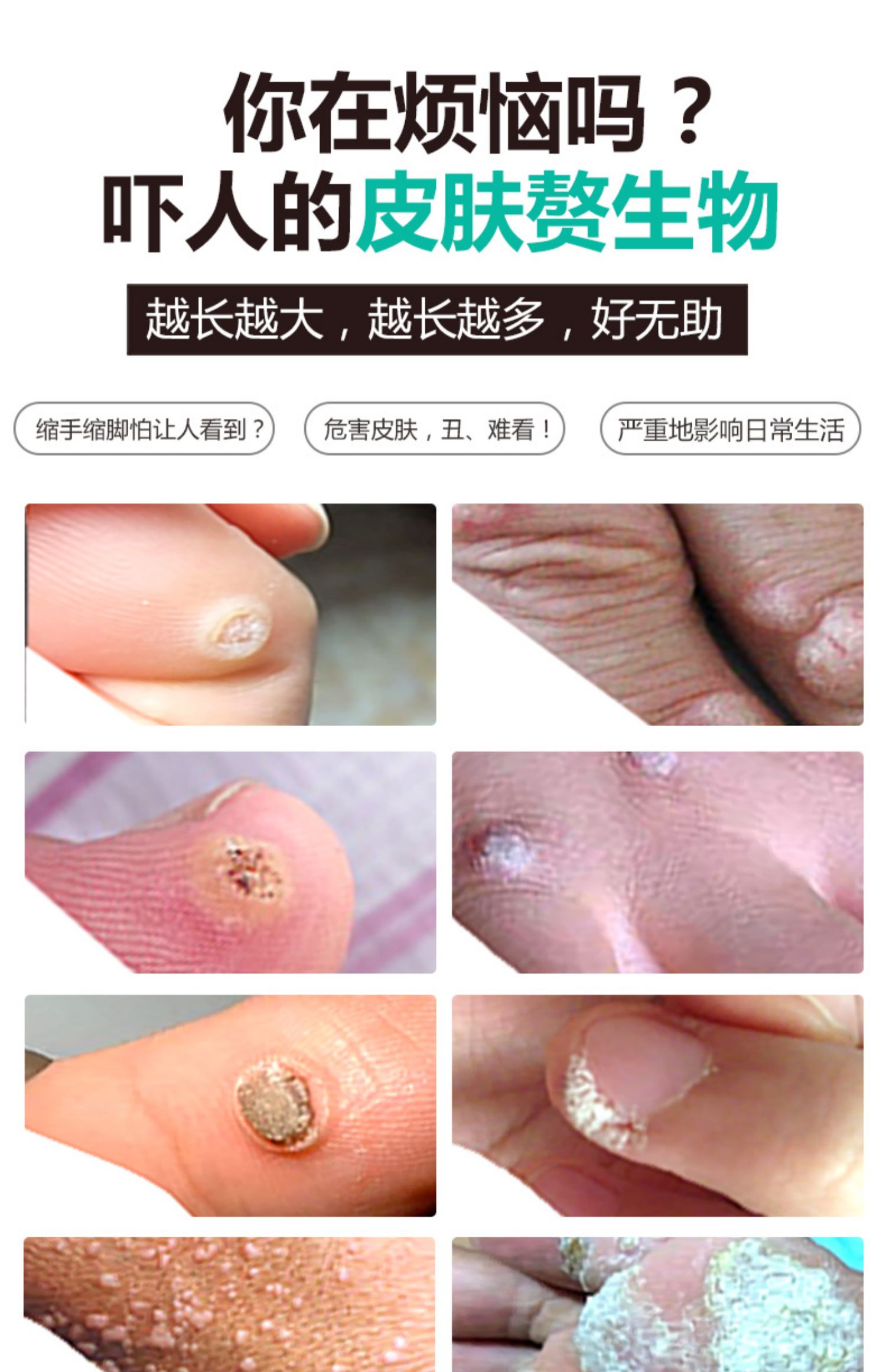 滴优正品鸡眼膏老茧贴跖疣膏去根去除尤净足部脚底血胞血泡刺专用