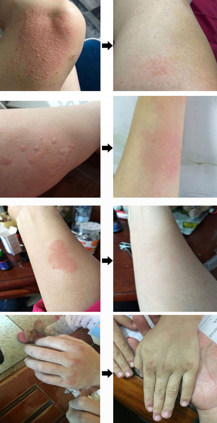 淘宝治疗皮肤痒急慢性荨麻疹膏