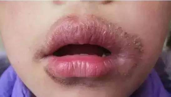 为什么嘴唇干的时候,不能舔和撕死皮?