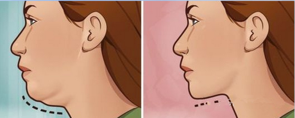 你那么瘦却有双下巴,两个成因很容易胖!