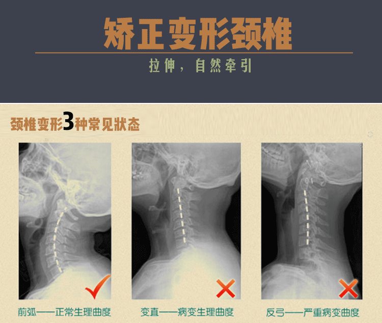 屏前长时间的不动 工作压力大 长时间积累下 很容易就有了颈椎变形