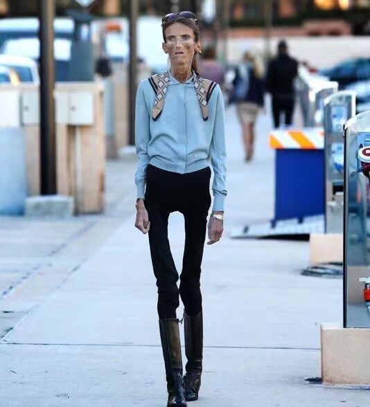 但是由於不正确的减肥,导致自己患上了厌食症.