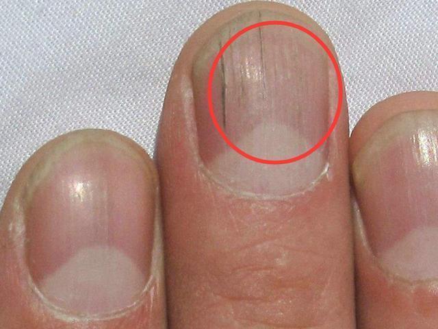 指甲上为什么会出现竖纹?要注意健康!