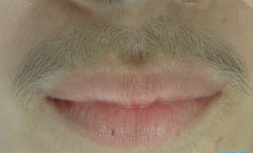 如何将女生唇毛清理干净?3个方法解决