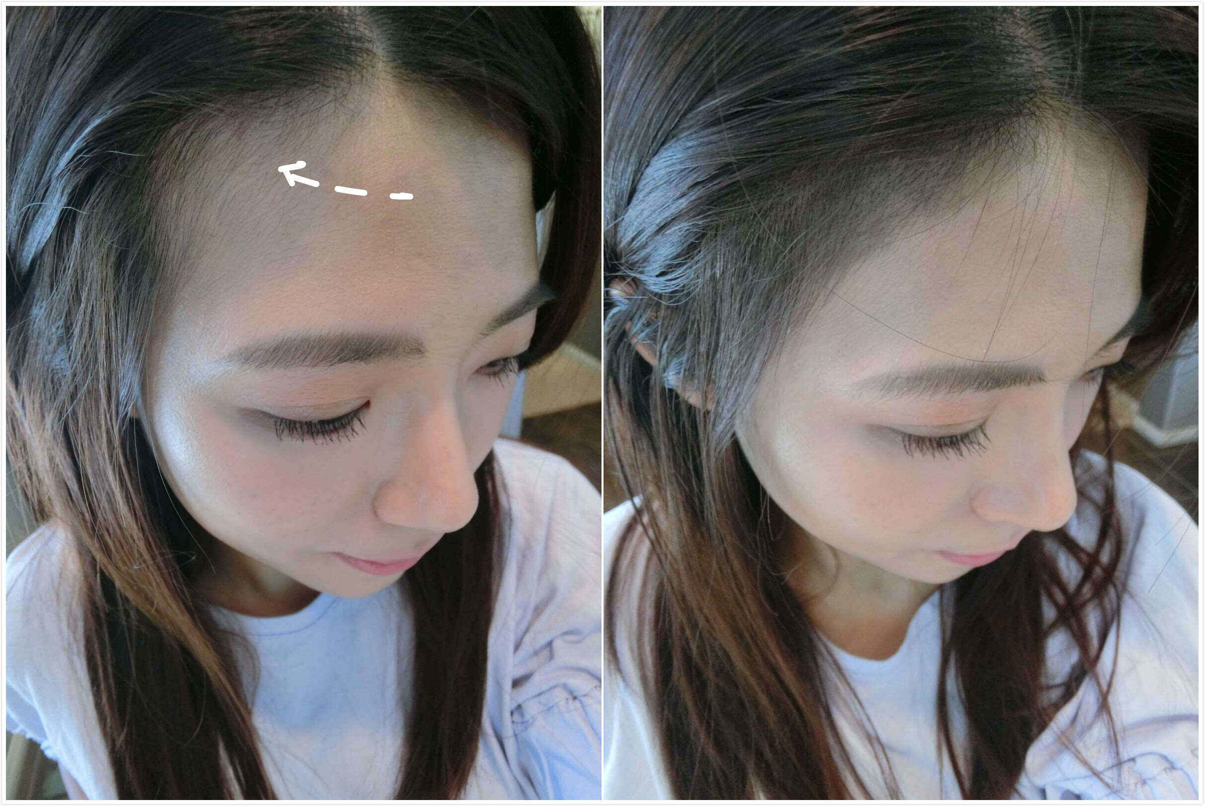 然而发际线后移无论是在男生还是女生身上都会发生,要想解决这个问题