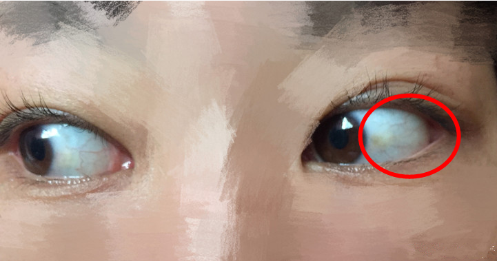 贫血的人有这5个特征,尤其是第3个!