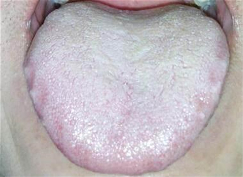 舌头长成这样,说明你身体已出了大问题