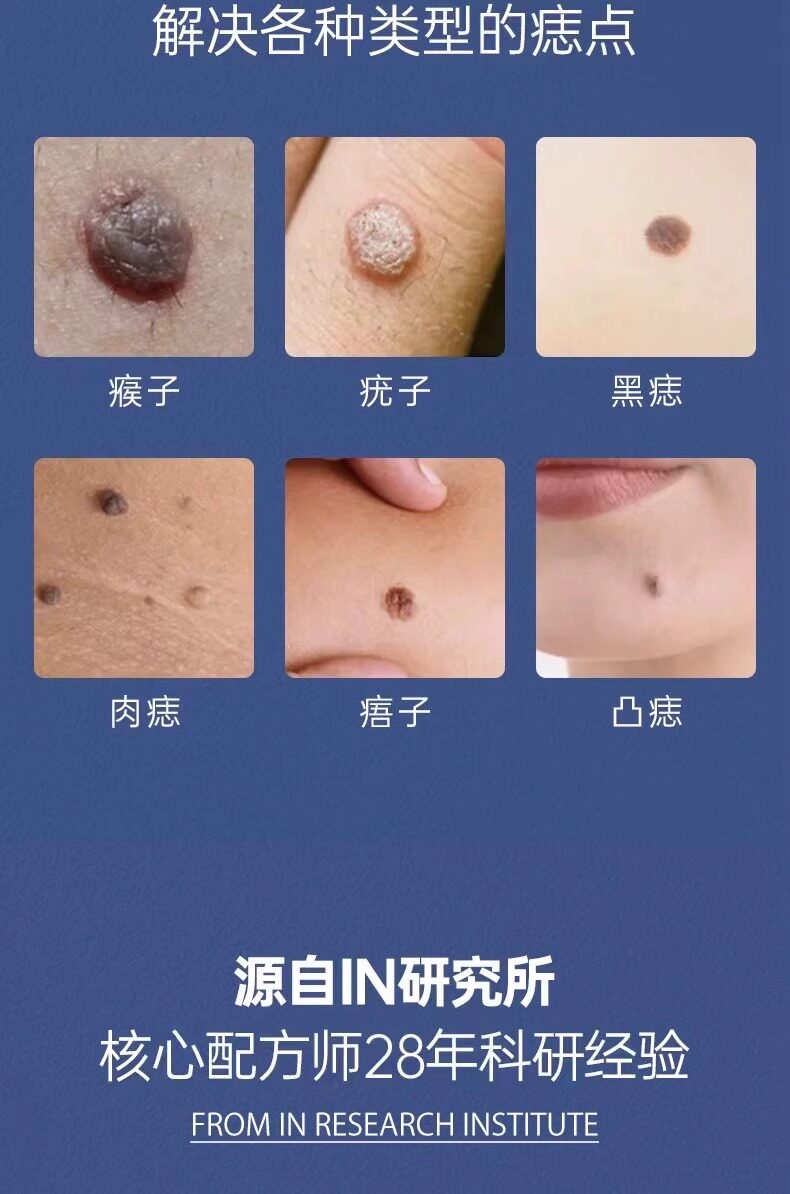 专研痣黑点肉痣痦子雀班 黄褐班 不留疤 全身可用