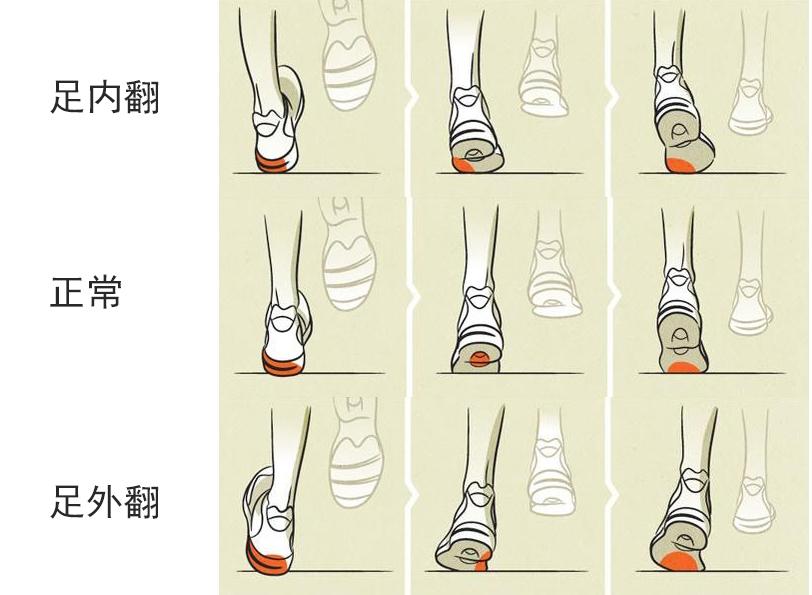 足内翻的脚型,有着脚背向内,脚心向外的趋向,过度内旋会加重双脚和