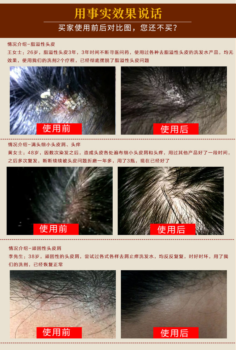 去头皮屑的药去头屑止痒洗发水治头癣头皮癣洗发水头皮毛囊炎药膏