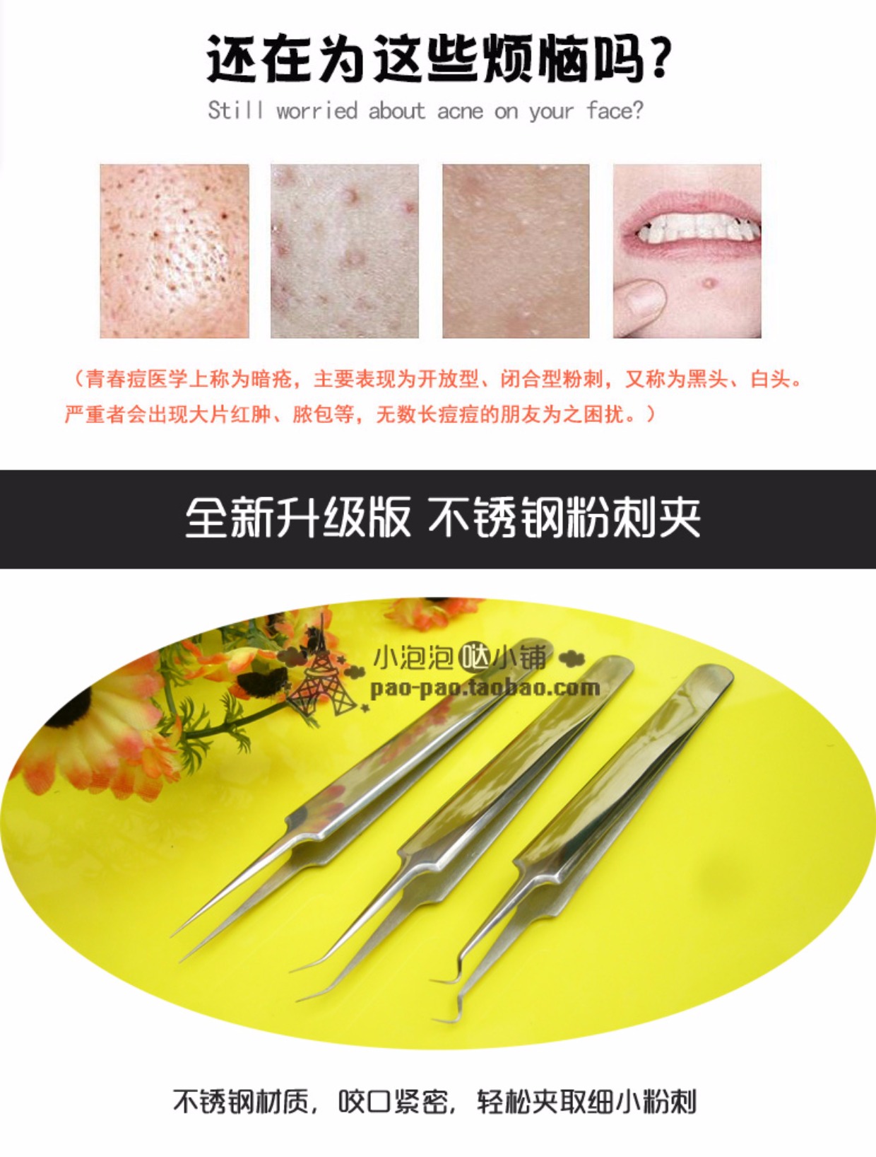 粉刺夹粉刺针挑痘针去黑头工具不锈钢镊子毛孔细胞夹暗疮针单个_7折