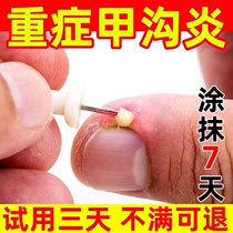 Nail groove Toenail Toenail long sarcoma embedded hook embedded nail groove Non-artifact Non-orthodontic device