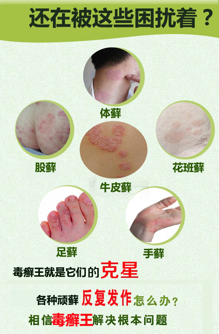 毒癣王牛皮癣药膏皮炎湿诊股藓膏大腿内侧阴囊肛门皮肤瘙痒止痒膏