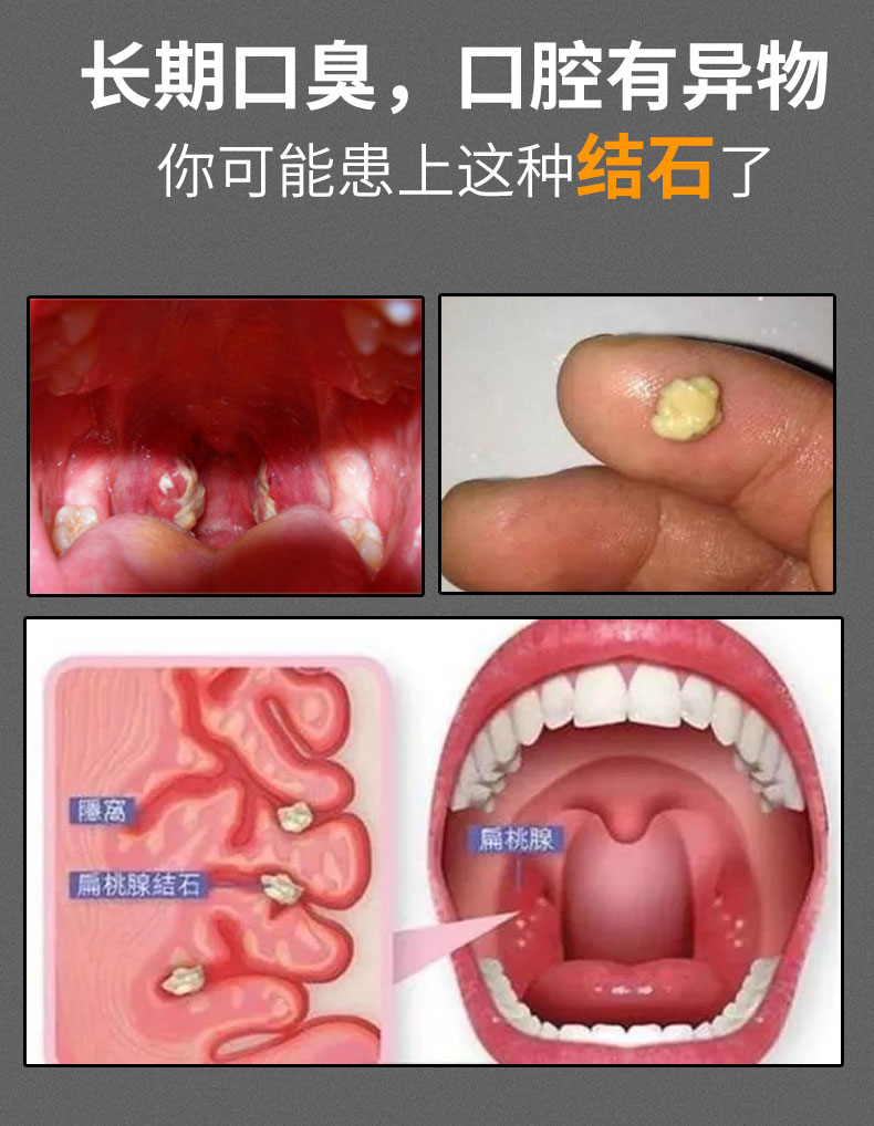 扁桃体结石工具去除取出隐窝神器扁导体去口气口臭家用扁桃体结石