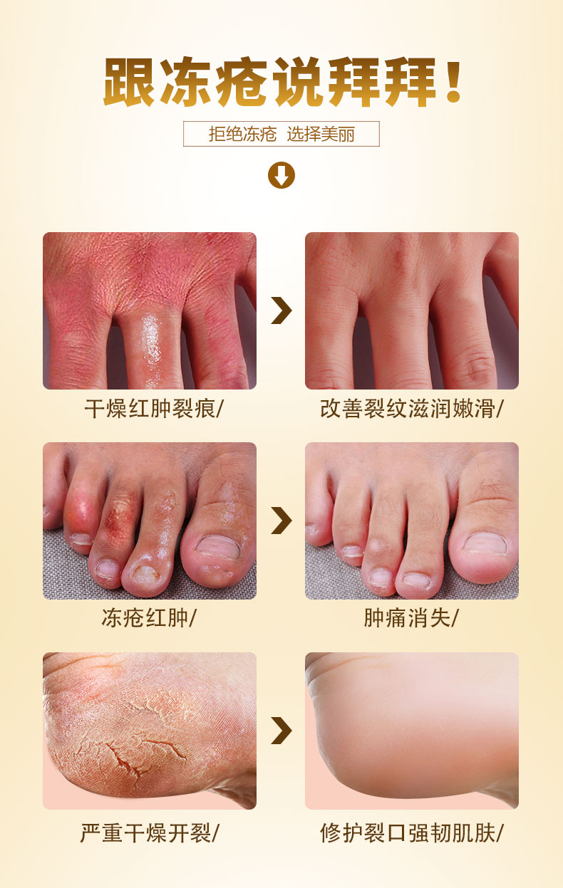 言西早冻疮膏 止痒 防冻防裂去手脚防冻膏冻手膏冻伤膏护手霜_vip购优