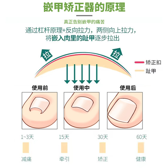 손톱 인레이 네일 보정 장치 트리밍을위한 아티팩트 발톱을위한 특별한 네일 클리퍼 세트 손톱 패치를위한 도구 손톱 인레이 네일 보정 장치 트리밍을위한 아티팩트 발톱을위한 특별한 네일 클리퍼 세트 손톱 패치를위한 도구