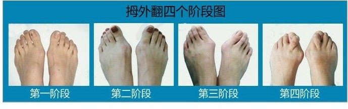 供应 大脚指拇指外翻正器 拇外翻矫正器 脚趾外翻 大脚骨纠正器