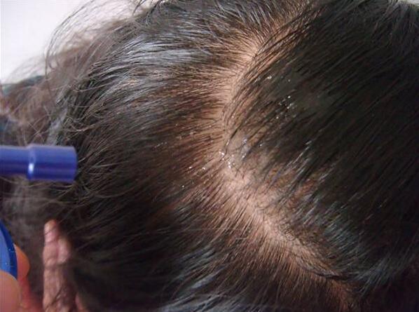 头发易油,抠下很多白色小颗粒,怎么办?