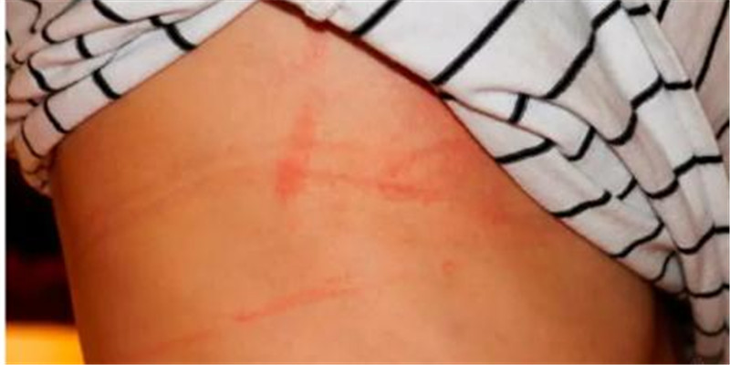 总觉得文胸不合适有勒痕?可能是因为