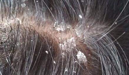 就可以摸到头皮上有凹凸不平的地方,一扣就是好多大块大块的  头皮屑