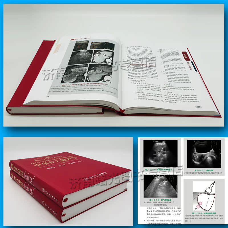 landmark monograph edited by chen minhua, liang ping, wang jinrui, 2 volumes of chinese interventional ultrasound, september 2017 reference , people's health press