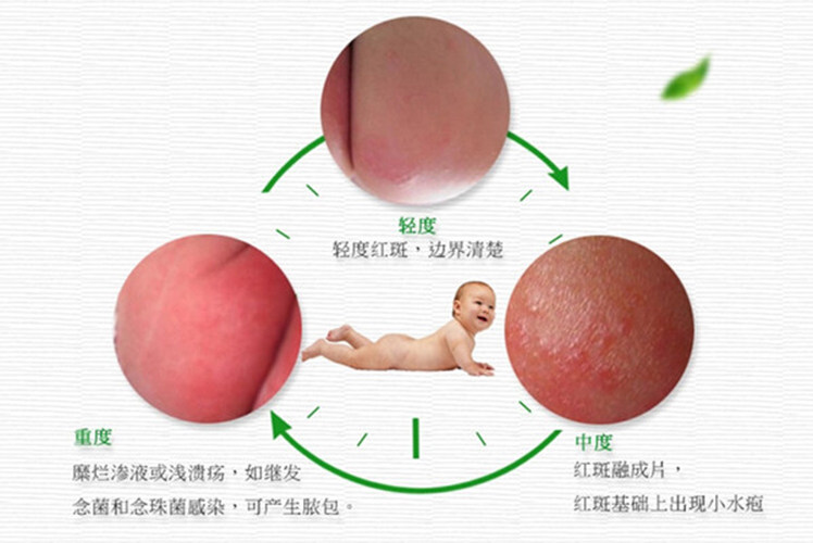 婆婆用土方给宝宝治红屁屁,我快急哭了