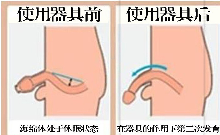 男用阴茎拉伸器锻炼男士负压真空泵增矫正弯曲直jj长大不吃粗粮