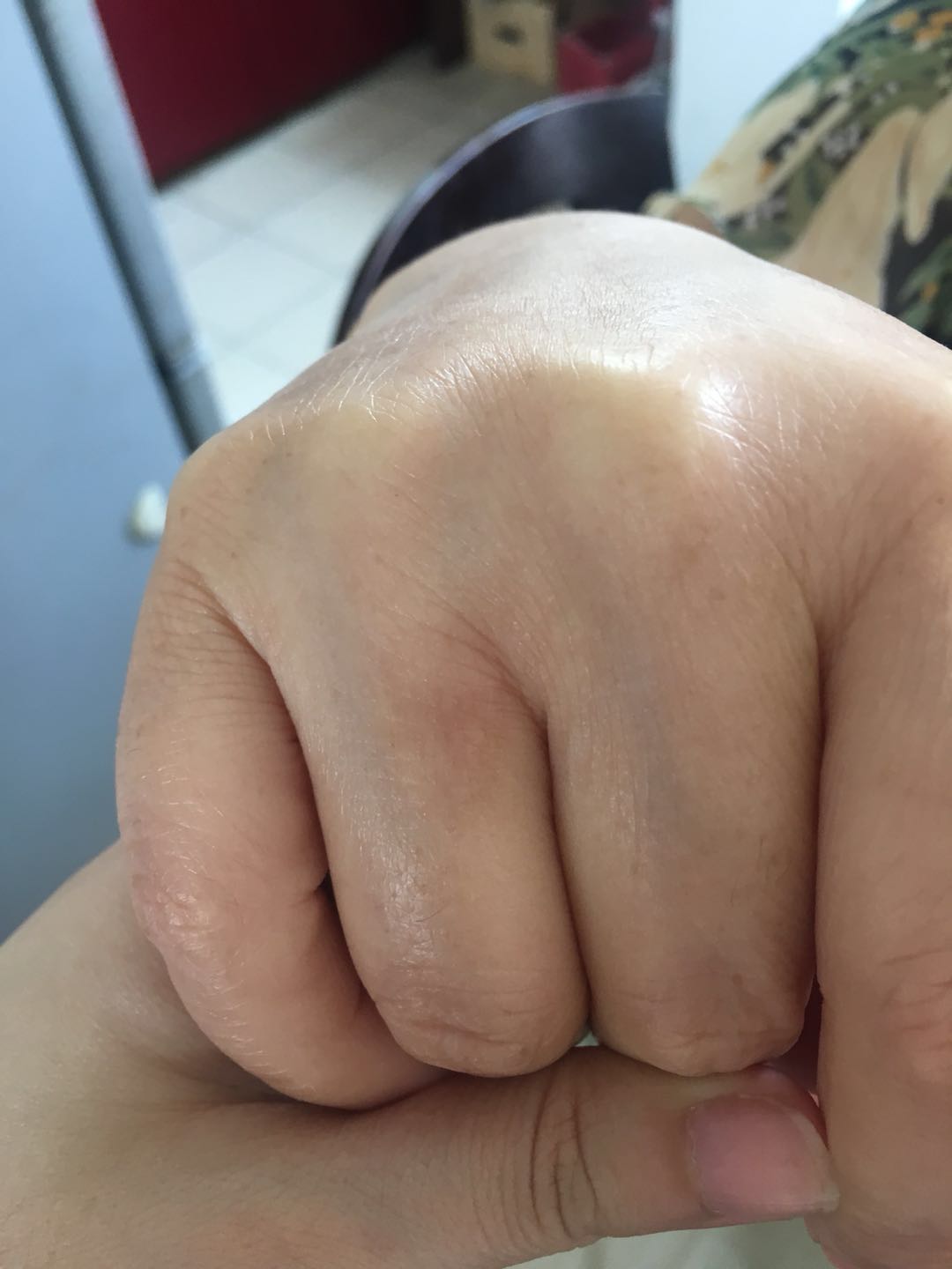 雄鹿壳聚糖护创凝胶 去疤痕 效果怎么样,真的好用吗?使用两周真实效果,第9张 雄鹿壳聚糖护创凝胶 去疤痕 效果怎么样,真的好用吗?使用两周真实效果,第9张